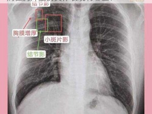 100%胸片曝光_100%胸片曝光：不同疾病在胸片上的具体表现有哪些？